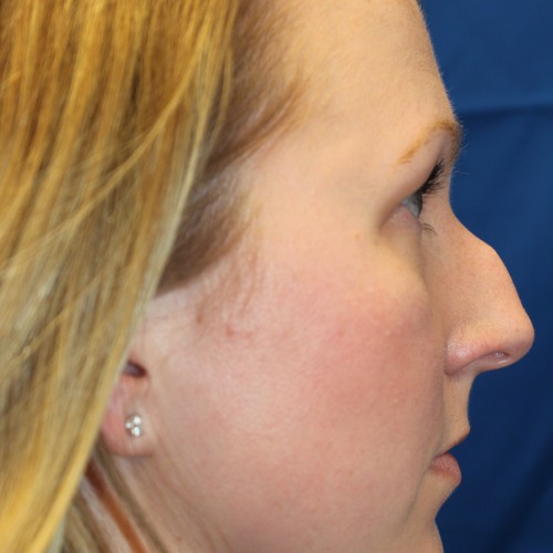 Non-surgical nose job - Rhinoplasty in Troy