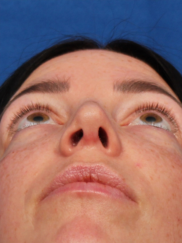 Female Cosmetic Rhinoplasty