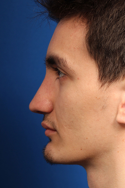 Male Cosmetic Rhinoplasty