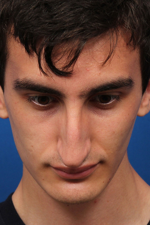 Male Cosmetic Rhinoplasty