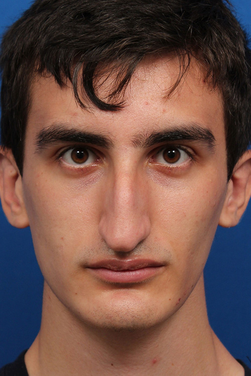 Male Cosmetic Rhinoplasty