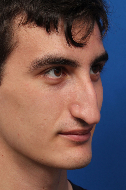 Male Cosmetic Rhinoplasty