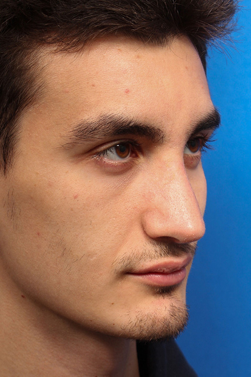 Male Cosmetic Rhinoplasty