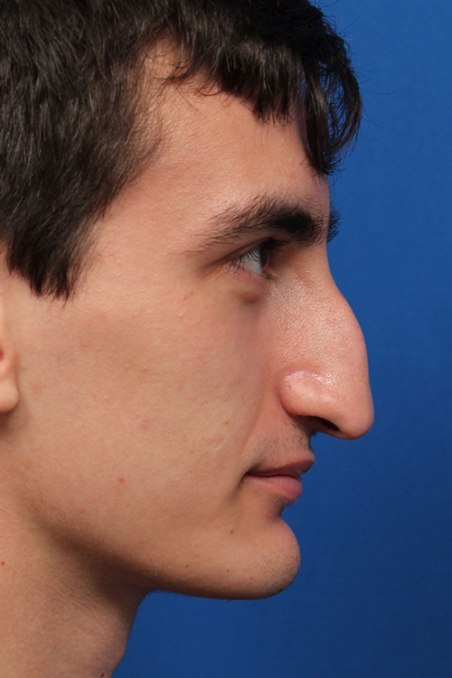 Male Cosmetic Rhinoplasty