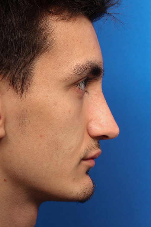 Male Cosmetic Rhinoplasty