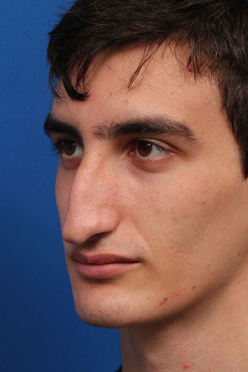 Male Cosmetic Rhinoplasty