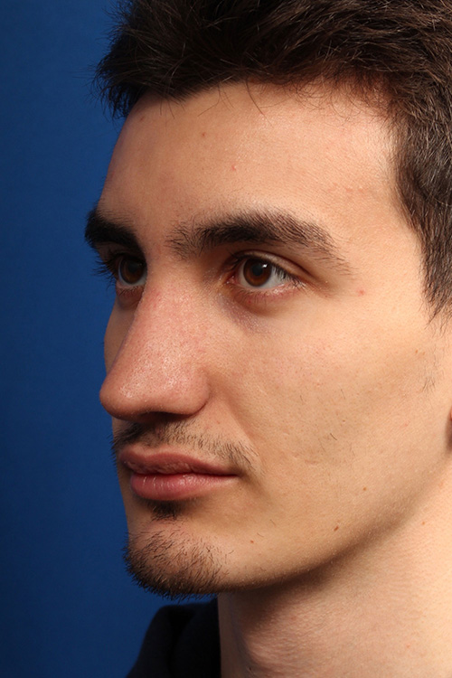 Male Cosmetic Rhinoplasty