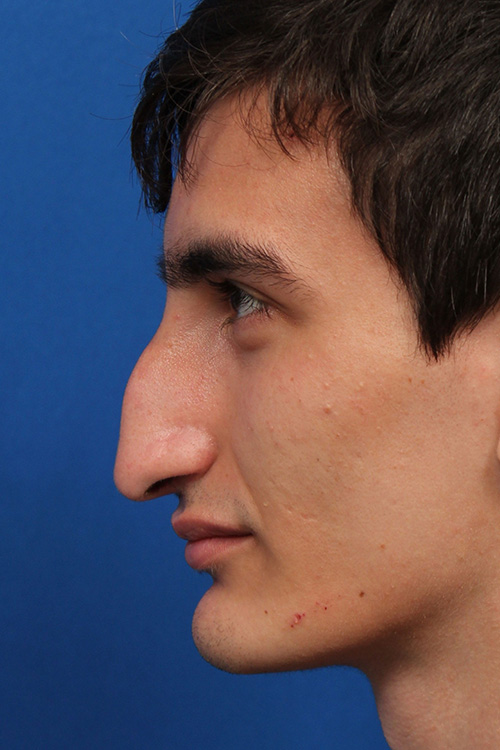 Male Cosmetic Rhinoplasty